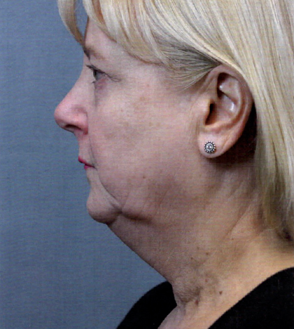 Facelift Before and After | Princeton Plastic Surgeons