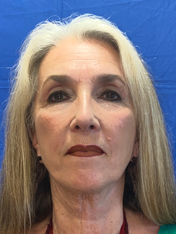 Facelift Before and After | Princeton Plastic Surgeons