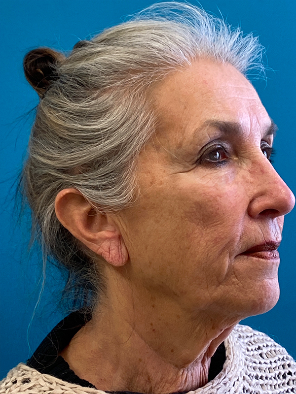 Facelift Before and After | Princeton Plastic Surgeons