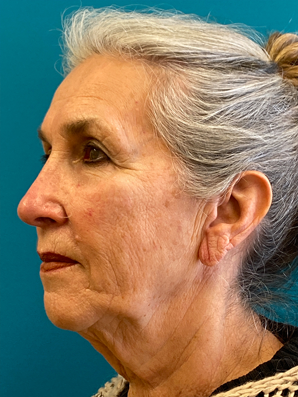 Facelift Before and After | Princeton Plastic Surgeons