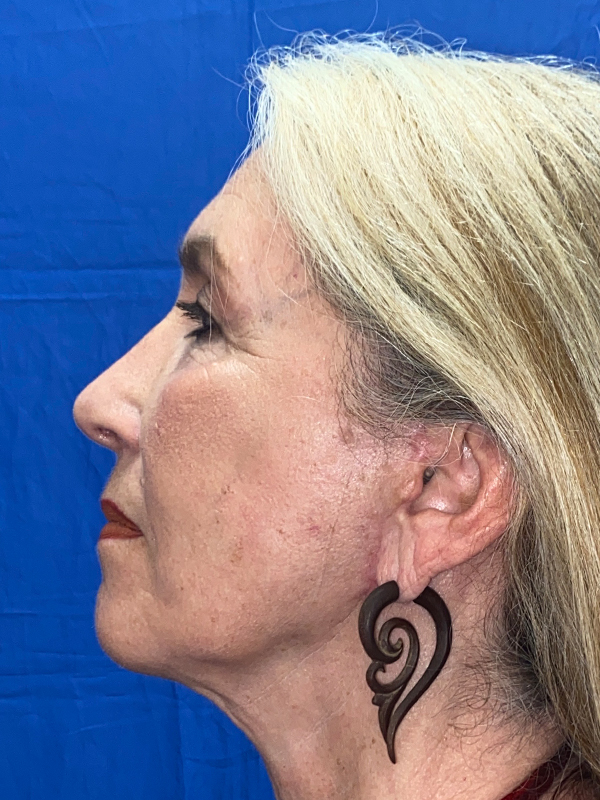 Facelift Before and After | Princeton Plastic Surgeons