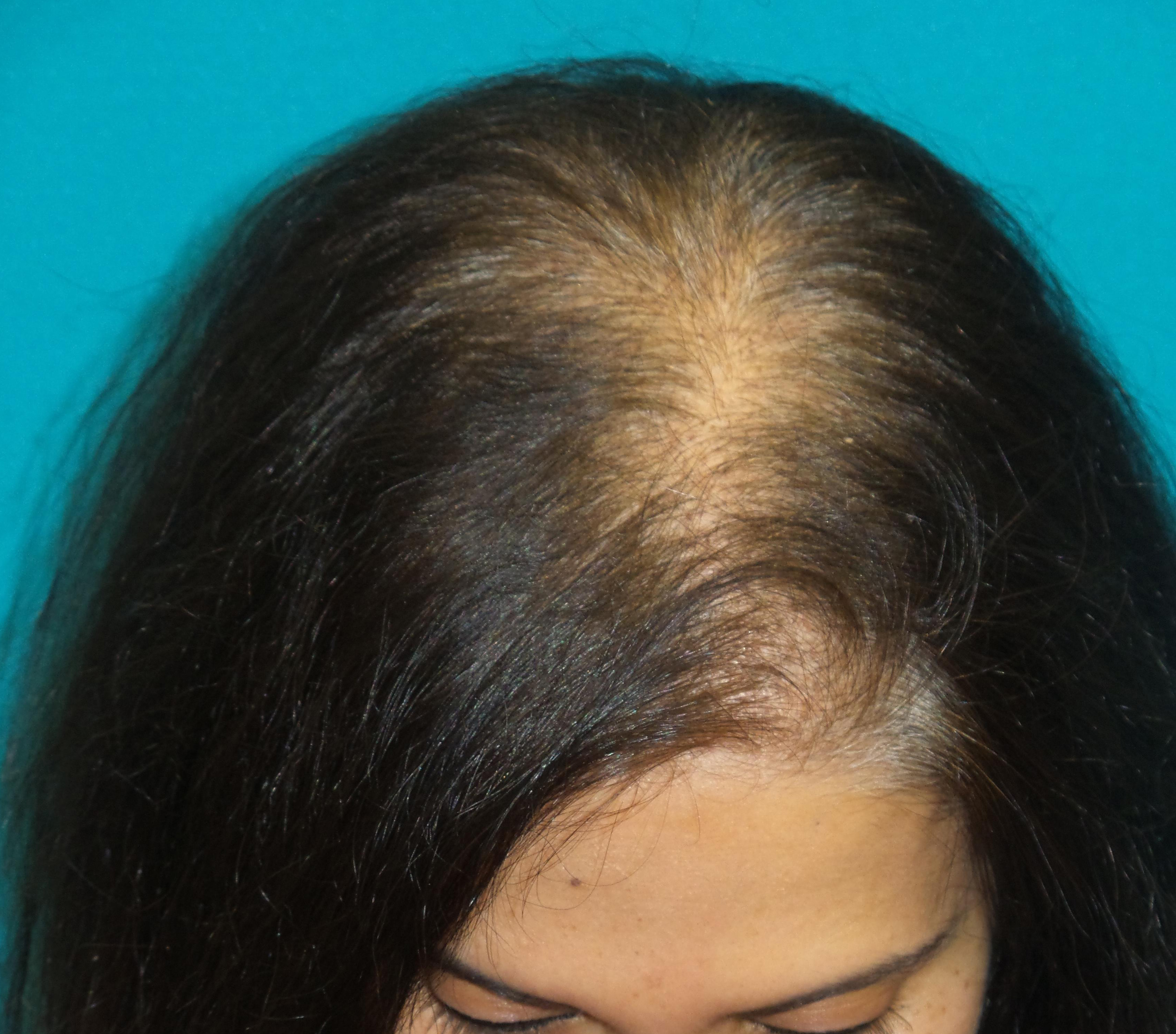 Female Hair Transplant Before and After | Princeton Plastic Surgeons