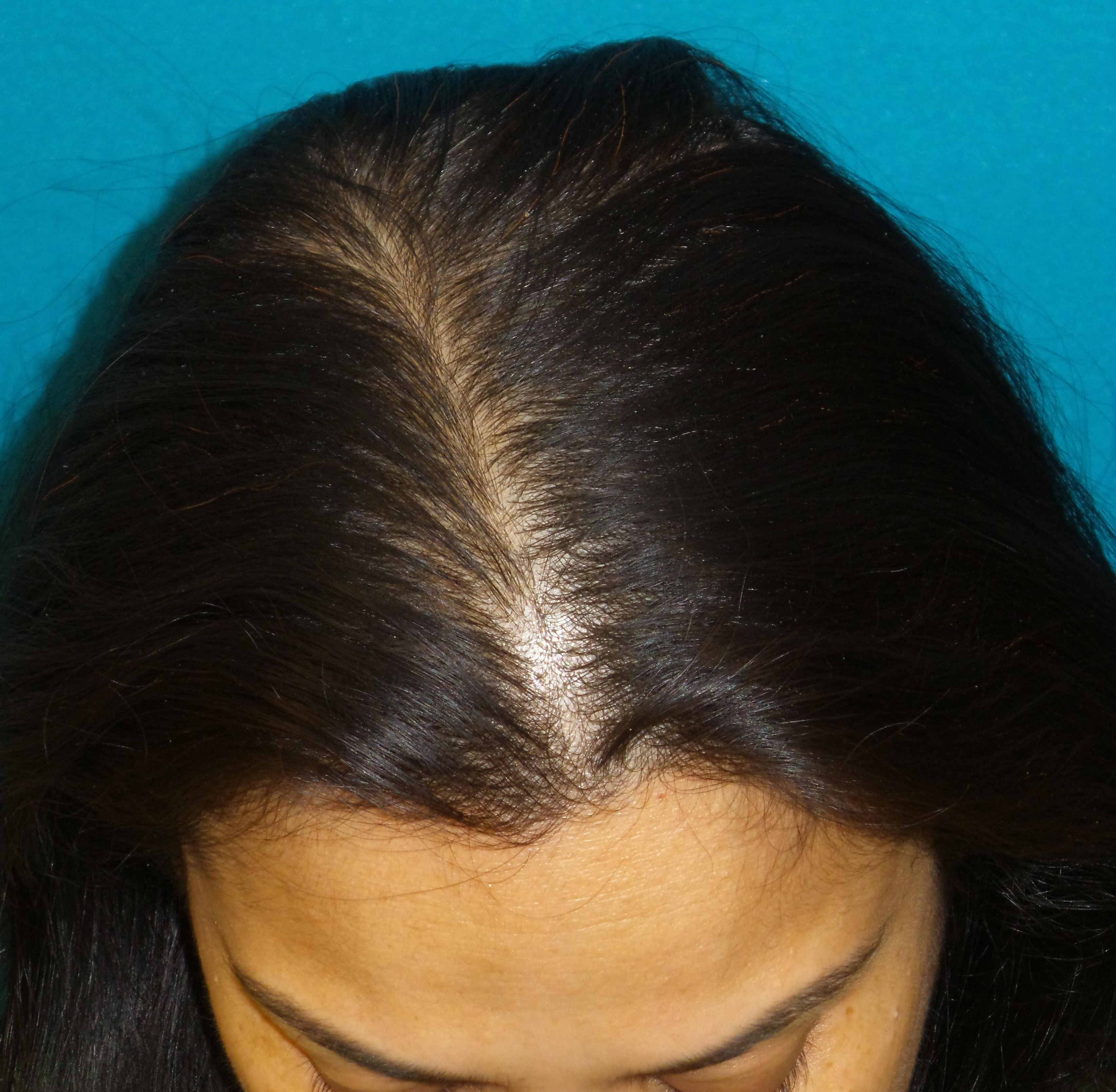 Female Hair Transplant Before and After | Princeton Plastic Surgeons