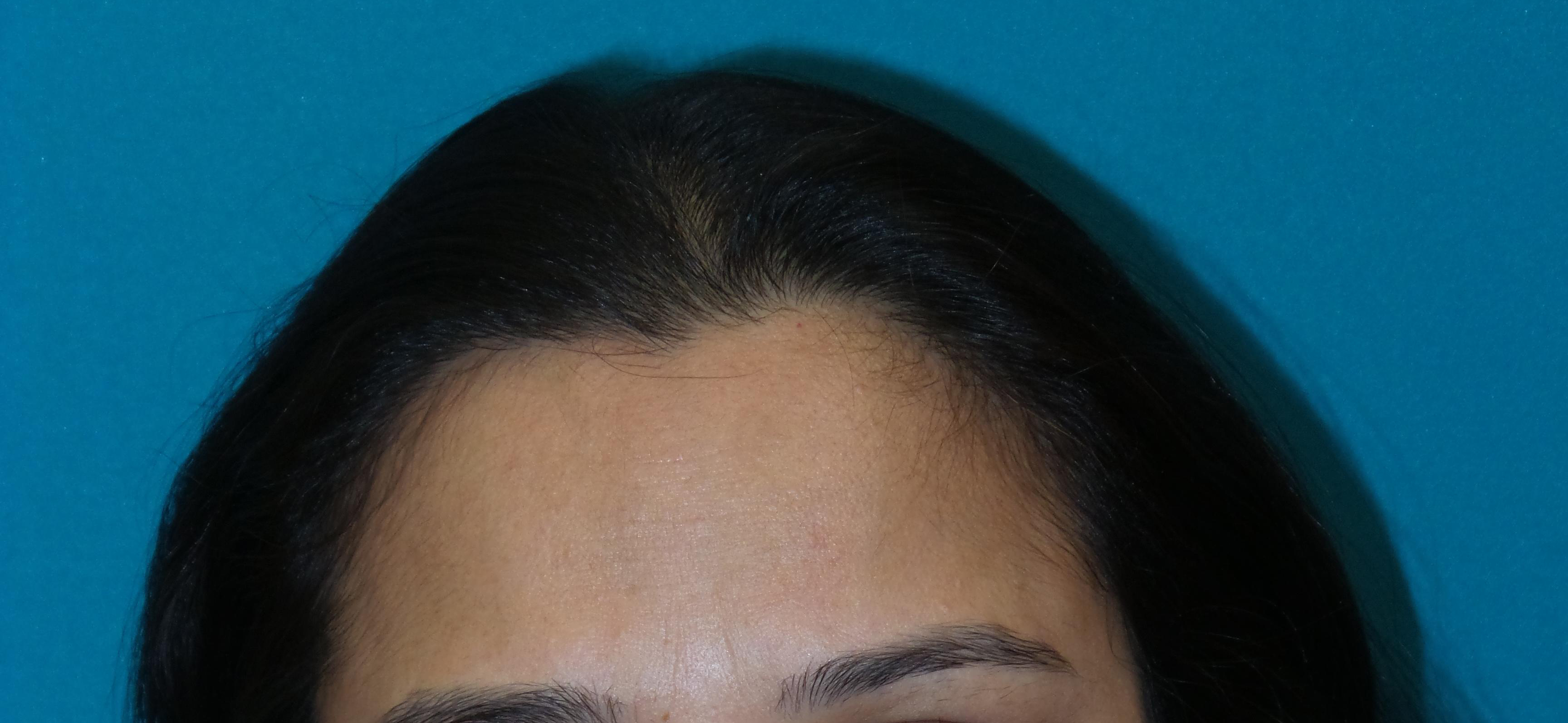 Female Hair Transplant Before and After | Princeton Plastic Surgeons