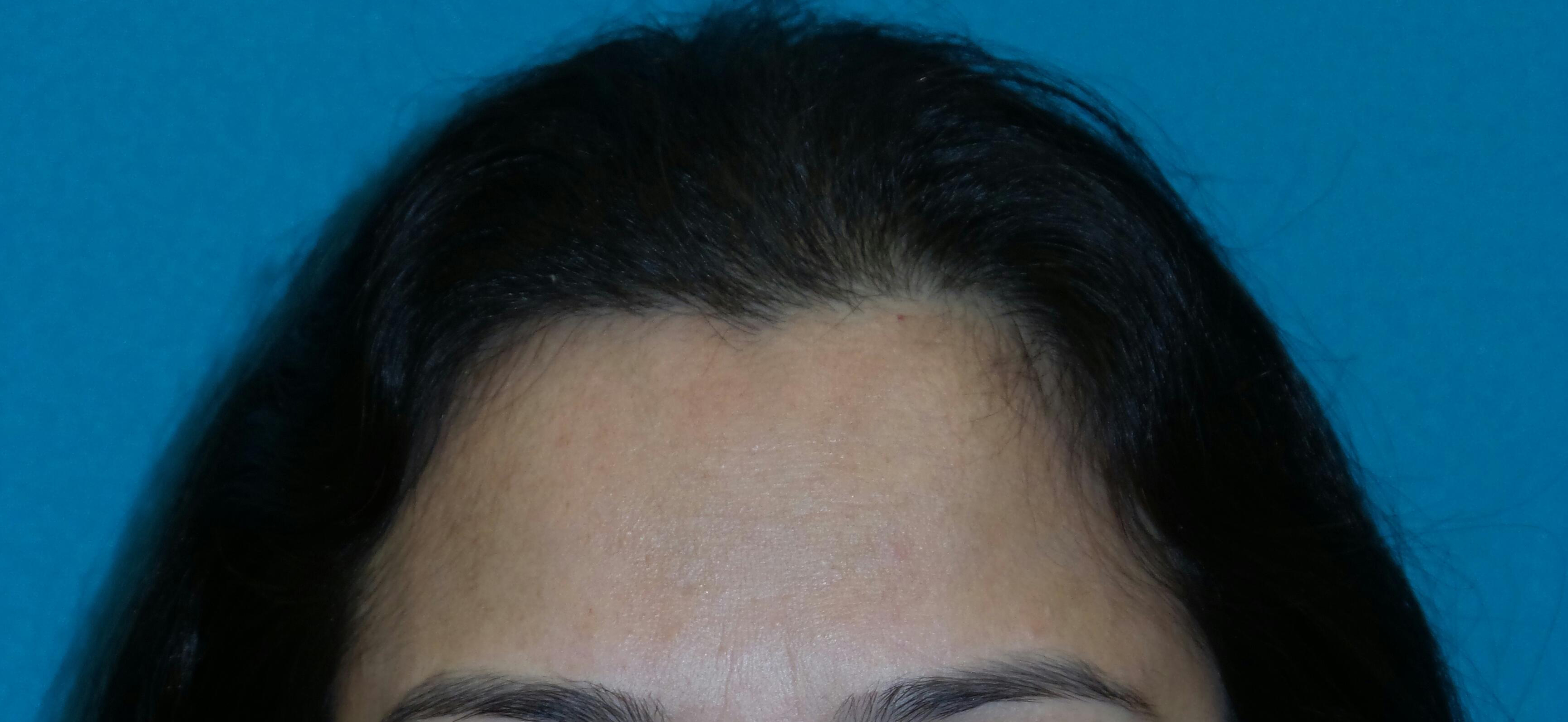 Female Hair Transplant Before and After | Princeton Plastic Surgeons