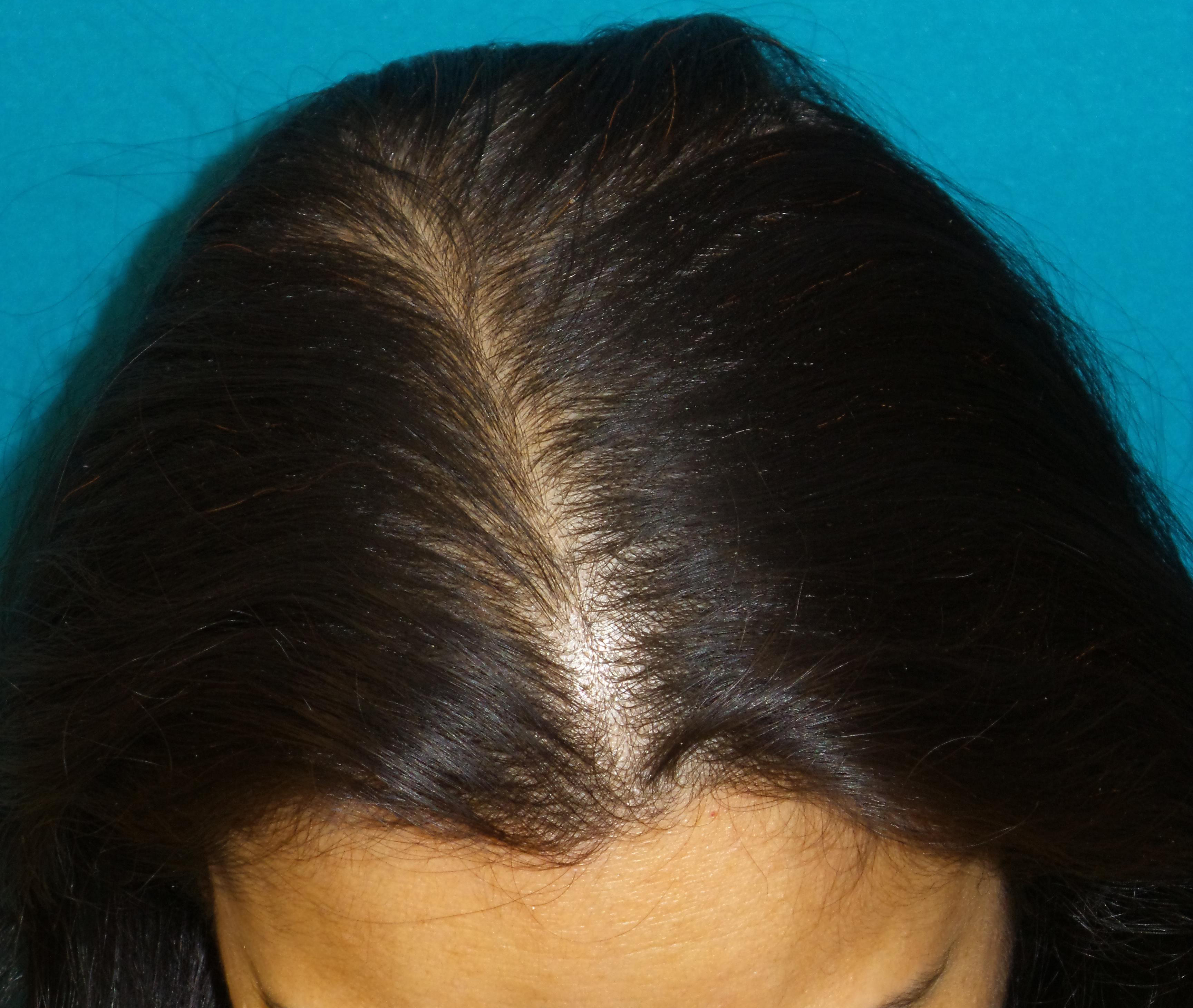 Female Hair Transplant Before and After | Princeton Plastic Surgeons