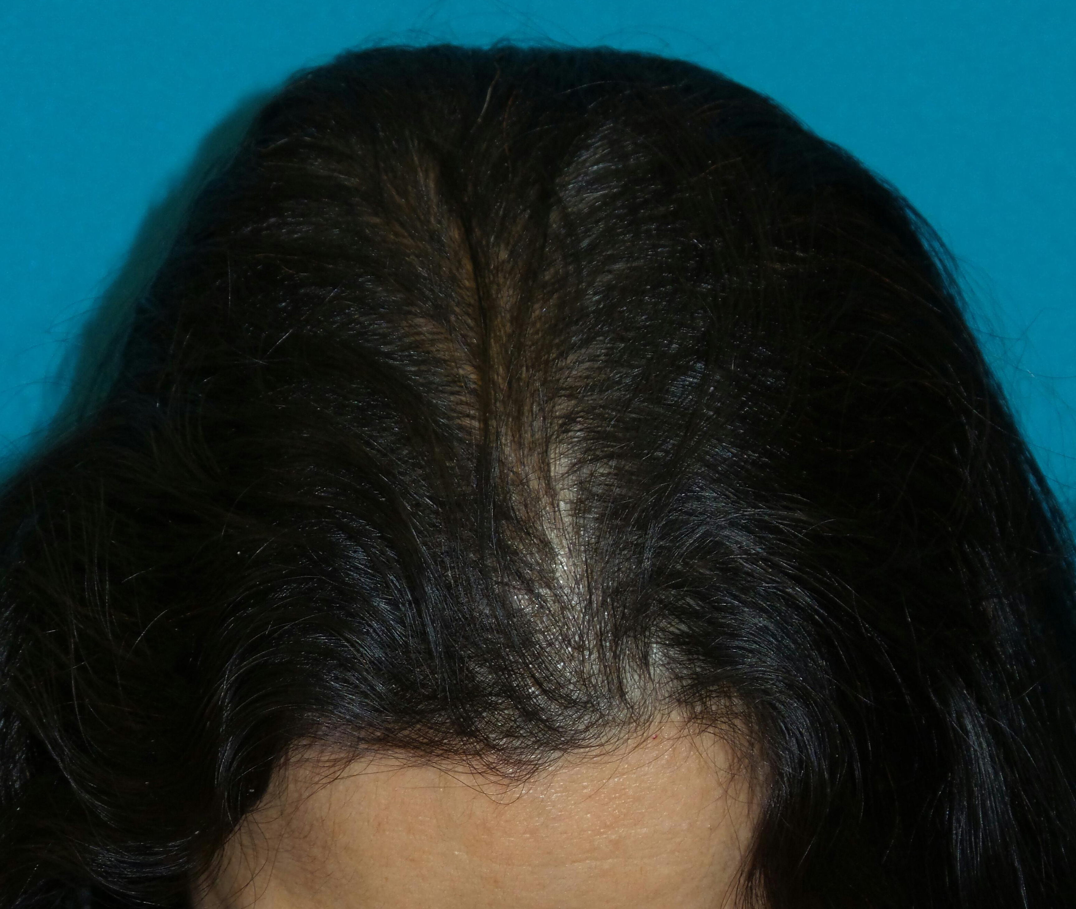 Female Hair Transplant Before and After | Princeton Plastic Surgeons