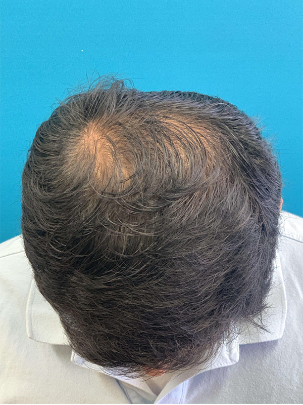 Hair Restoration Before and After | Princeton Plastic Surgeons