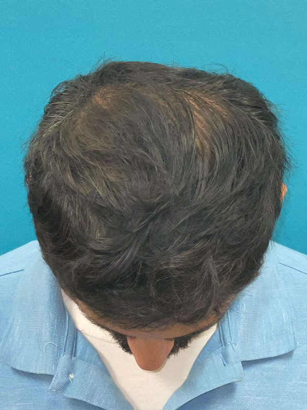 Hair Restoration Before and After | Princeton Plastic Surgeons