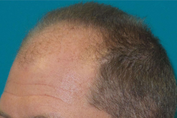 Hair Restoration Before and After | Princeton Plastic Surgeons