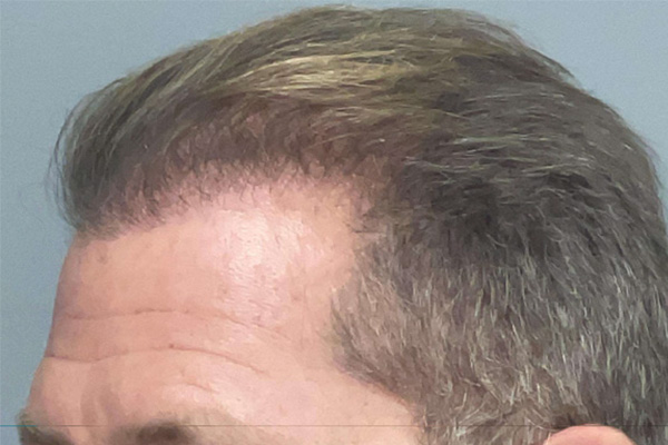 Hair Restoration Before and After | Princeton Plastic Surgeons