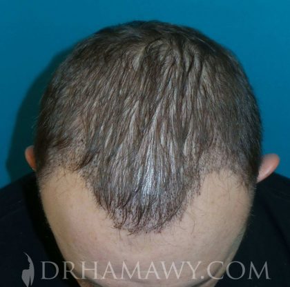 Hair Transplant Before and After | Princeton Plastic Surgeons