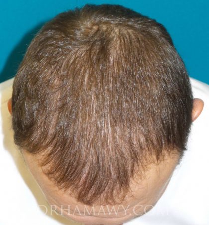 Hair Transplant Before and After | Princeton Plastic Surgeons