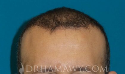 Hair Transplant Before and After | Princeton Plastic Surgeons