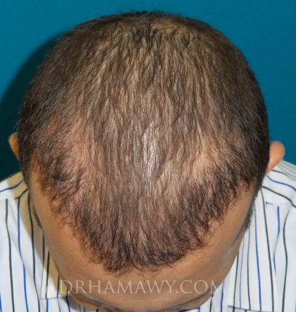 Hair Transplant Before and After | Princeton Plastic Surgeons