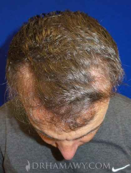 Hair Transplant Before and After | Princeton Plastic Surgeons