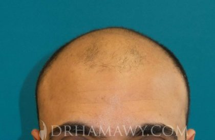 Hair Transplant Before and After | Princeton Plastic Surgeons