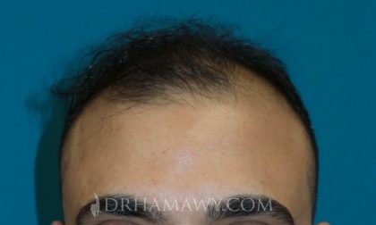 Hair Transplant Before and After | Princeton Plastic Surgeons