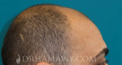 Hair Transplant Before and After | Princeton Plastic Surgeons