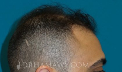 Hair Transplant Before and After | Princeton Plastic Surgeons