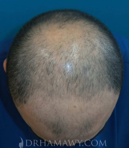 Hair Transplant Before and After | Princeton Plastic Surgeons