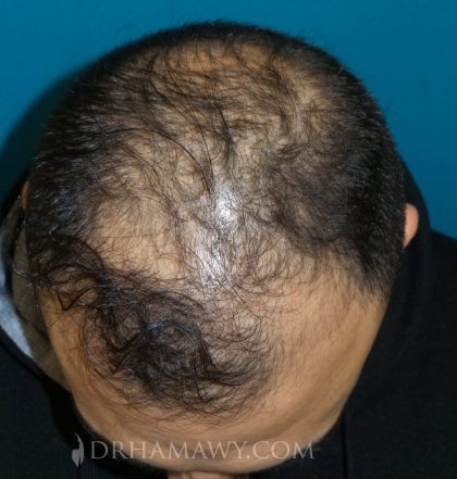 Hair Transplant Before and After | Princeton Plastic Surgeons