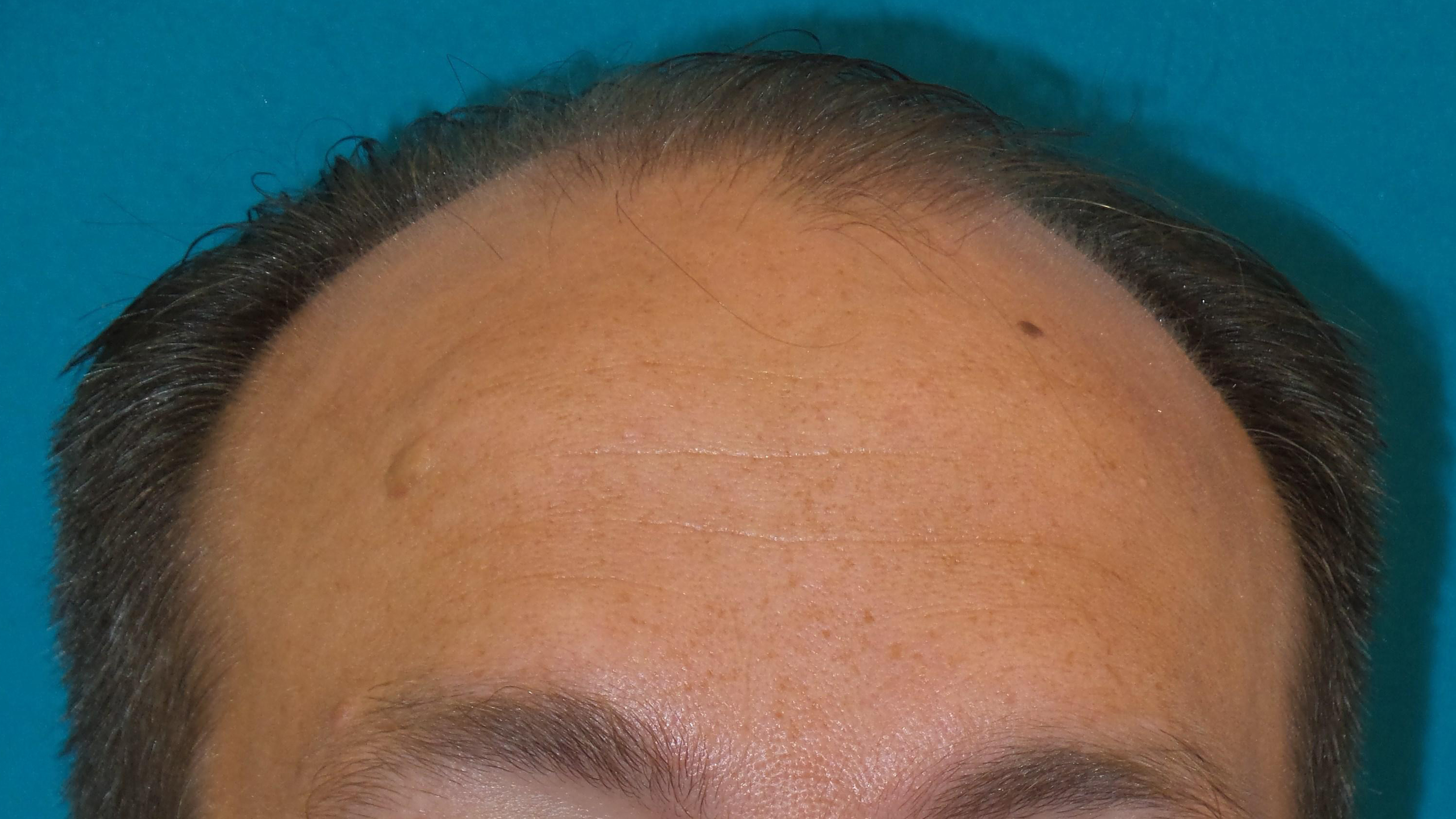 Hair Transplant Before and After | Princeton Plastic Surgeons