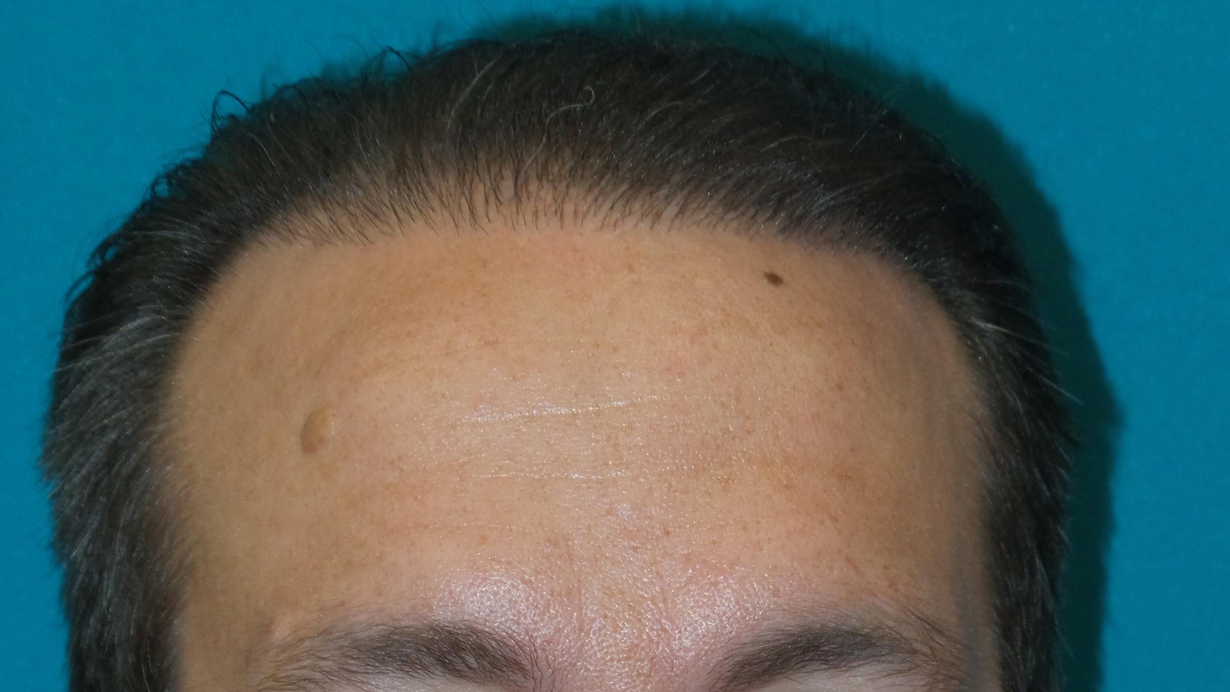 Hair Transplant Before and After | Princeton Plastic Surgeons