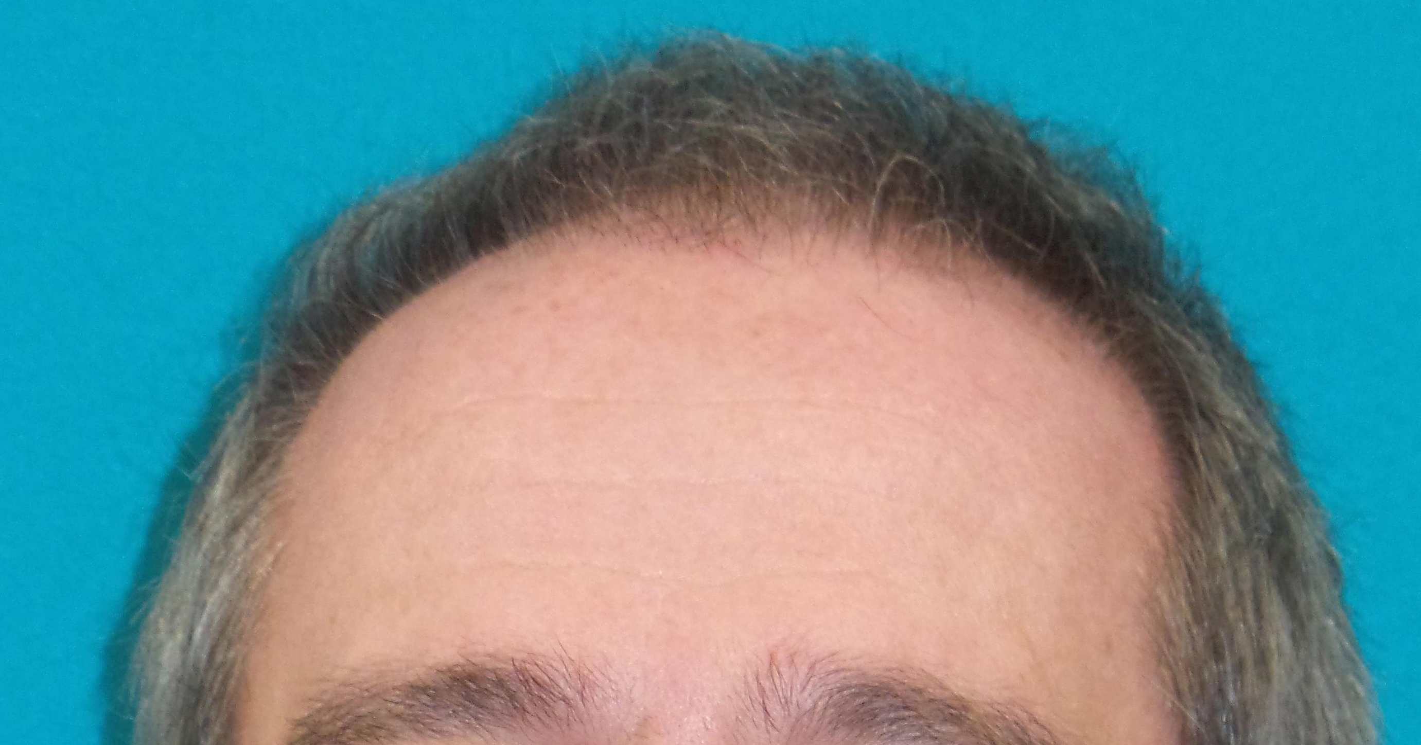 Hair Transplant Before and After | Princeton Plastic Surgeons