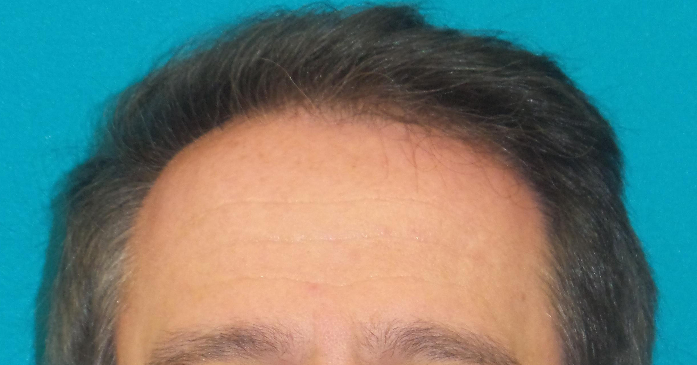 Hair Transplant Before and After | Princeton Plastic Surgeons