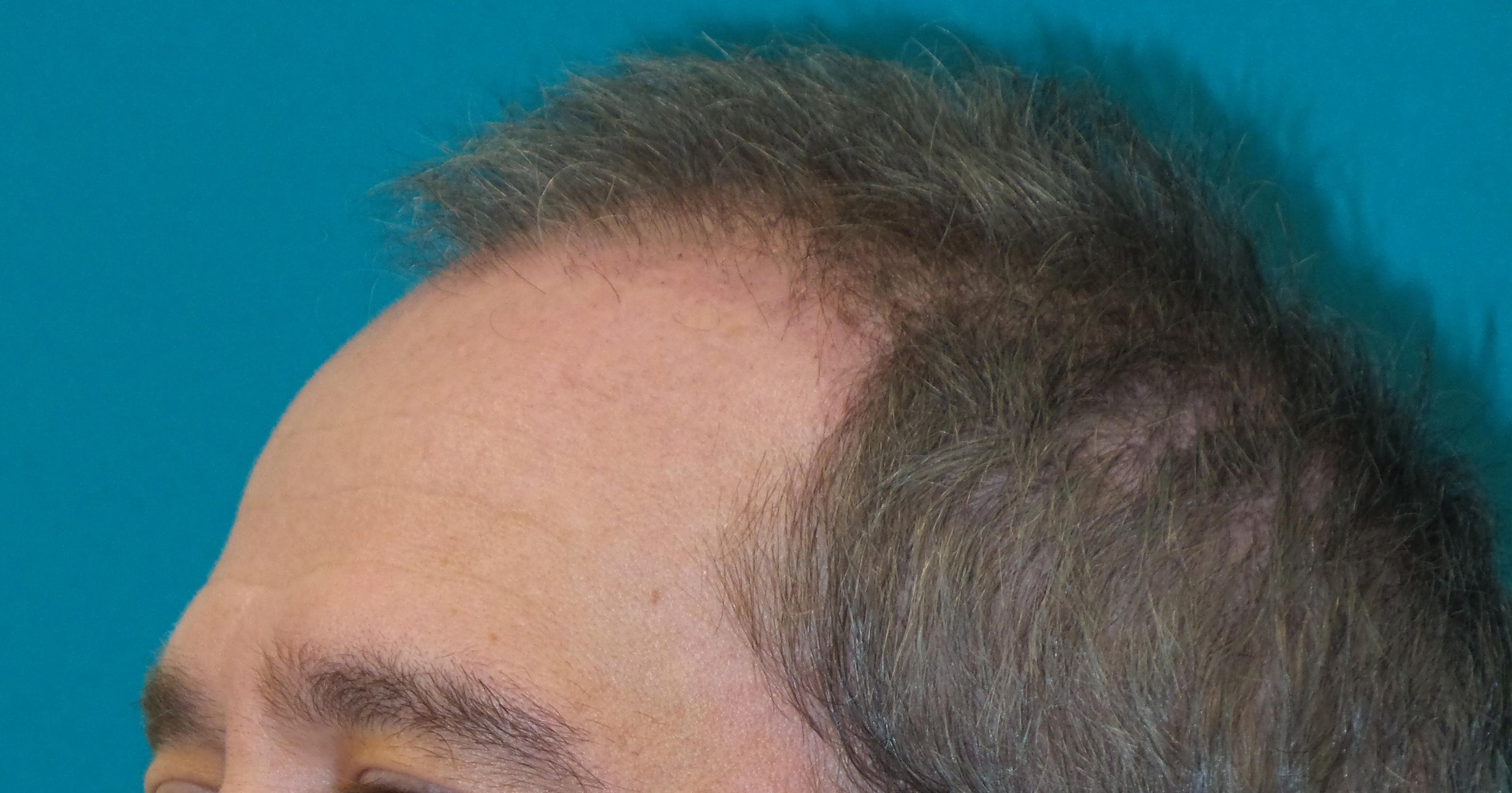 Hair Transplant Before and After | Princeton Plastic Surgeons