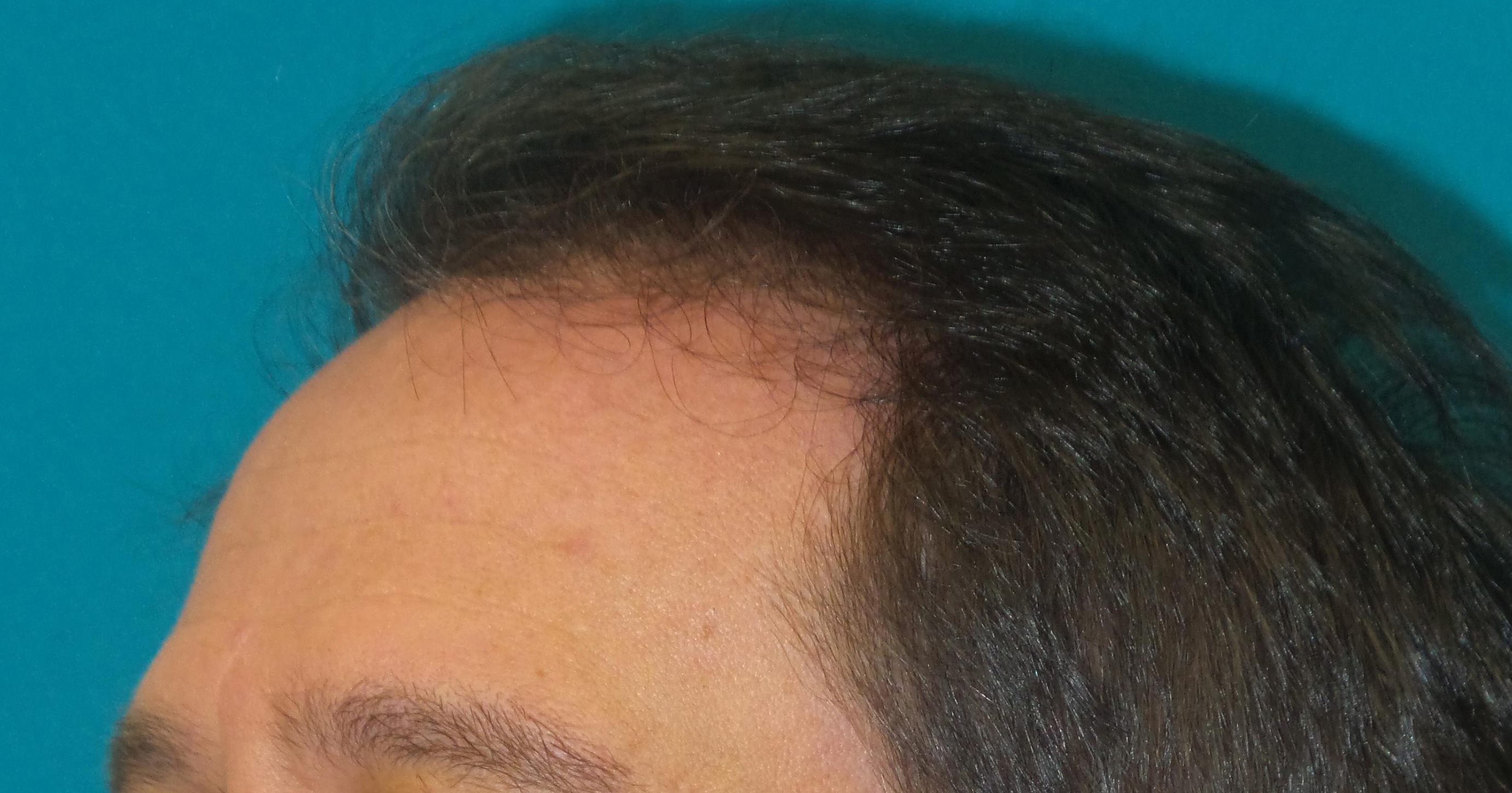 Hair Transplant Before and After | Princeton Plastic Surgeons