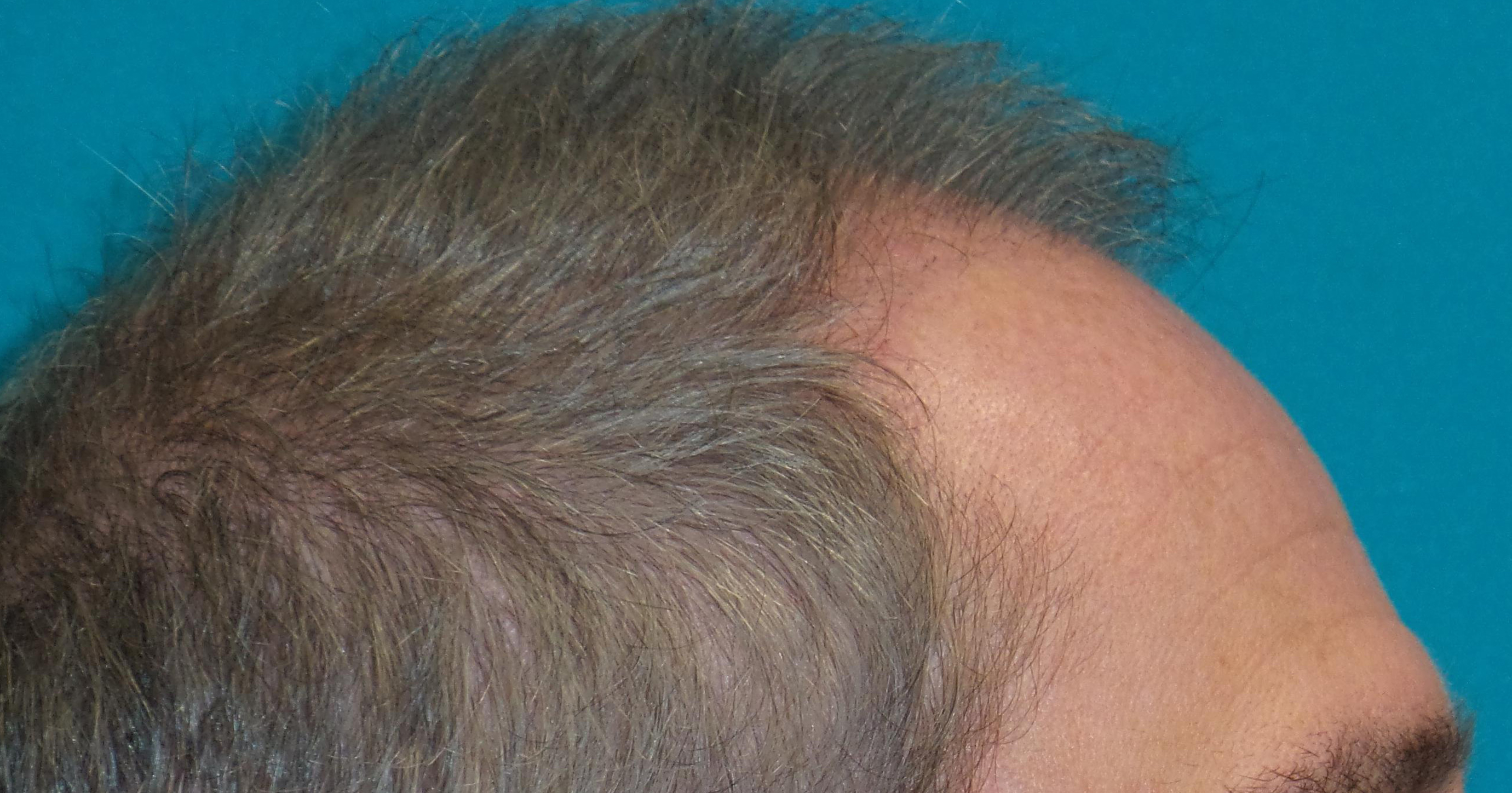 Hair Transplant Before and After | Princeton Plastic Surgeons