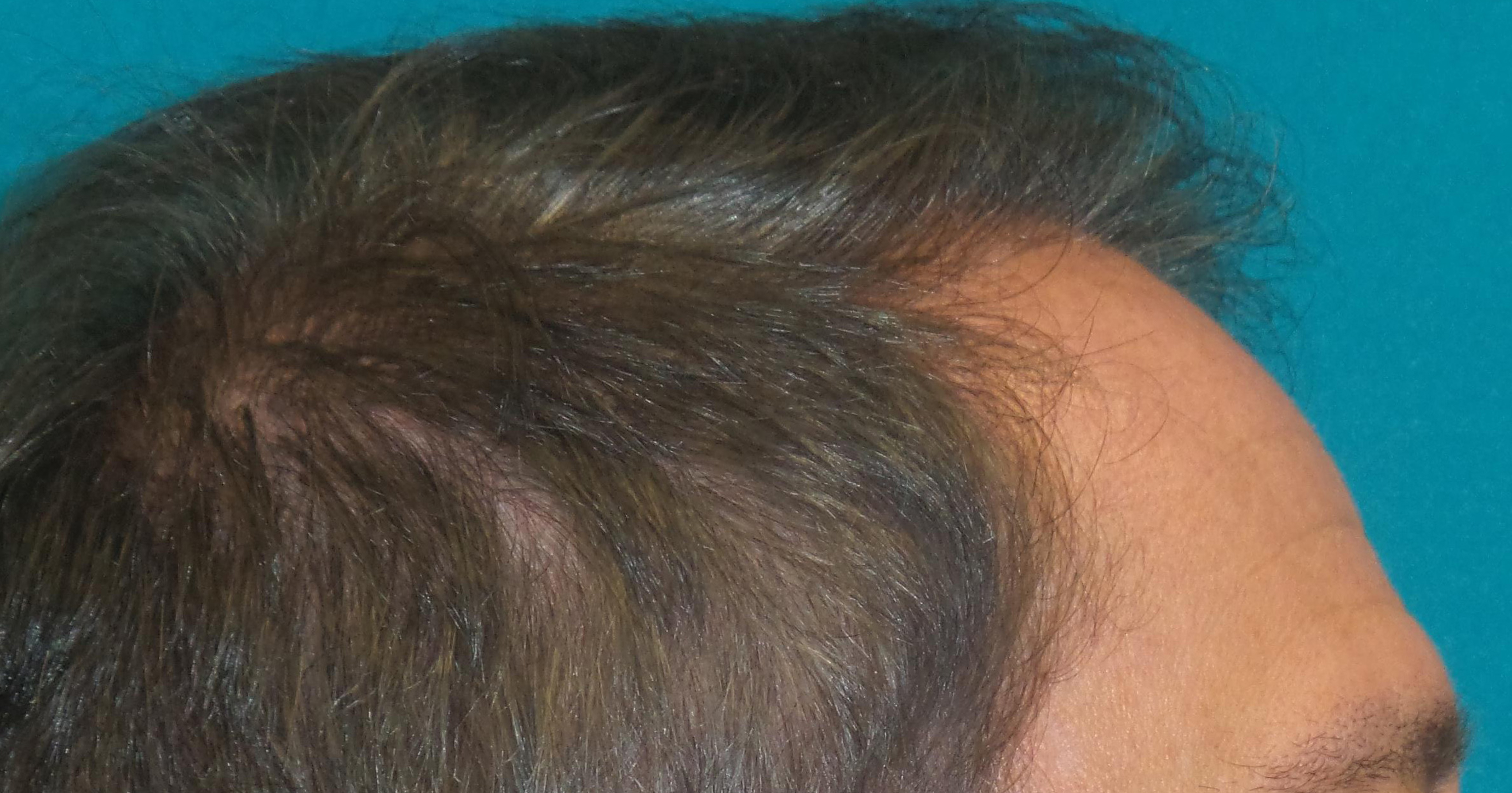 Hair Transplant Before and After | Princeton Plastic Surgeons