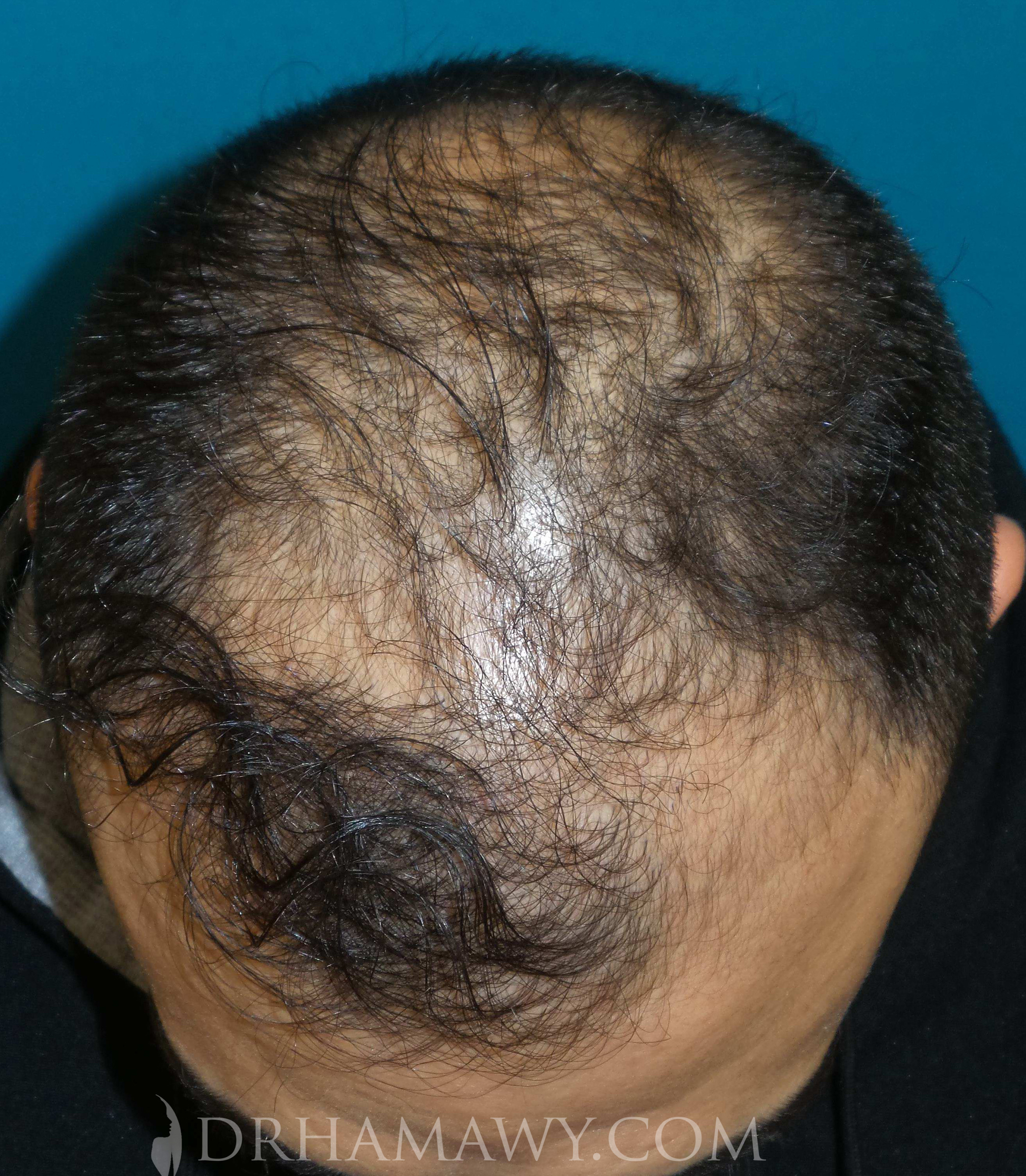 Hair Transplant Before and After | Princeton Plastic Surgeons