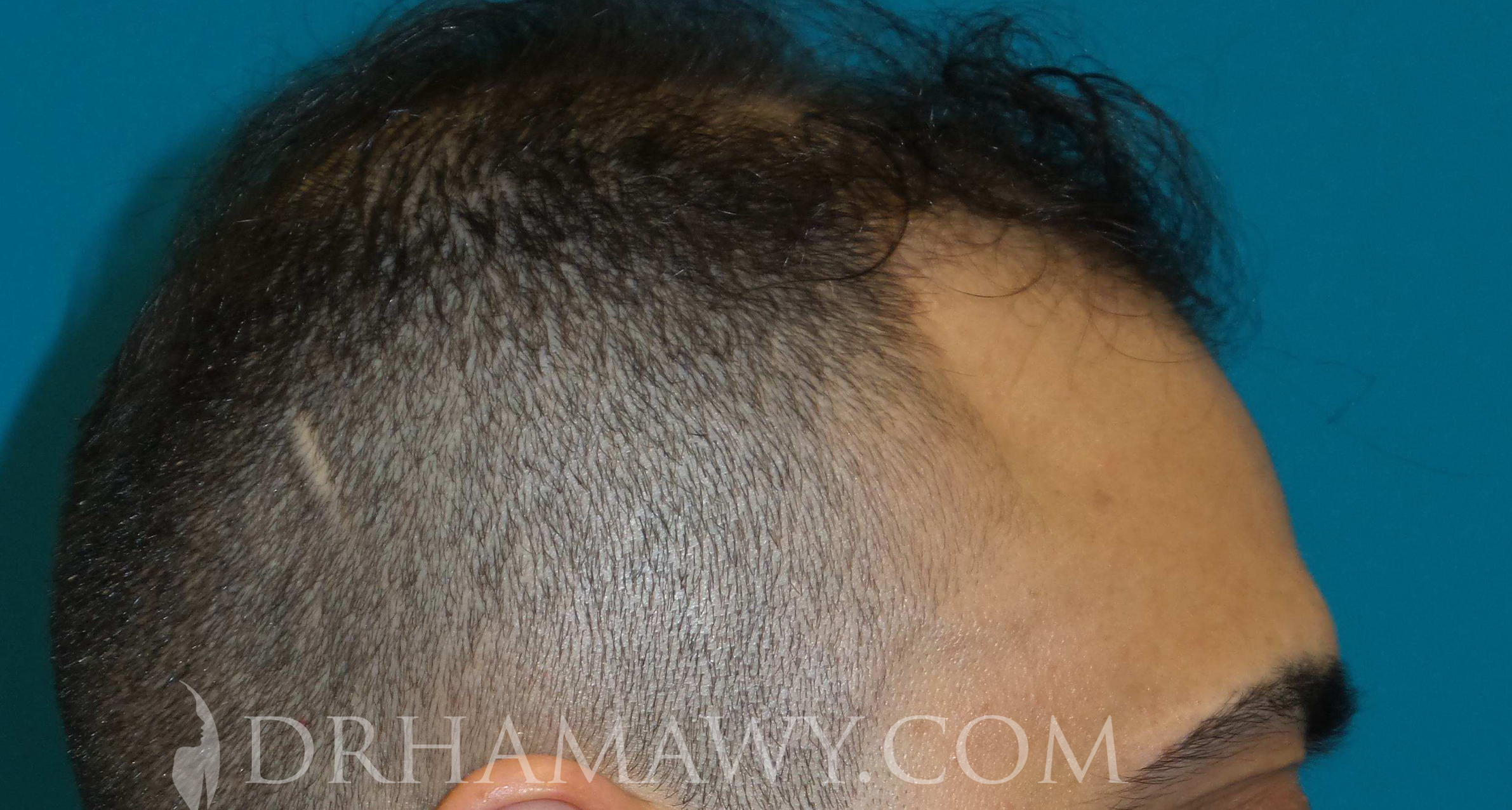 Hair Transplant Before and After | Princeton Plastic Surgeons