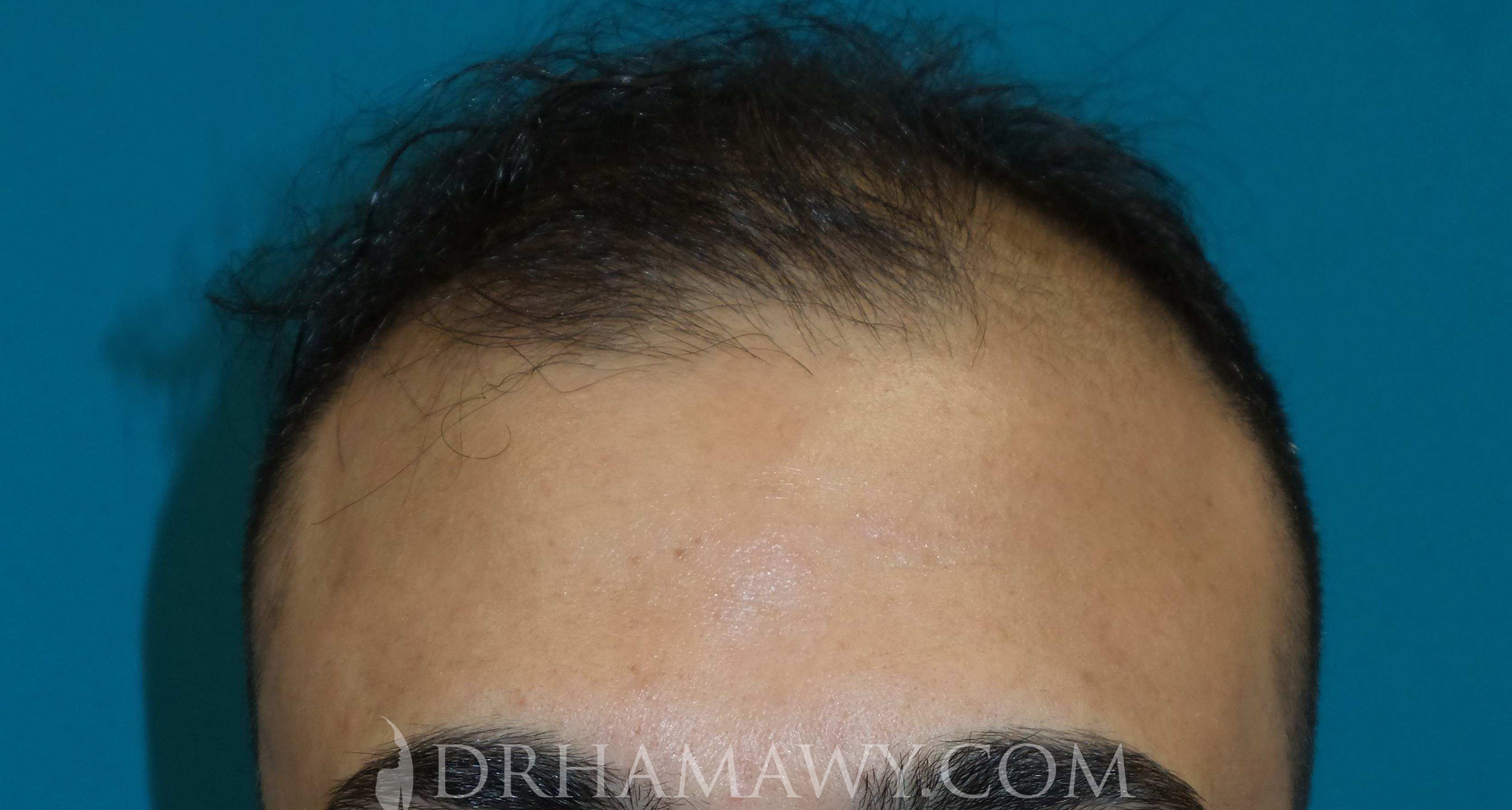 Hair Transplant Before and After | Princeton Plastic Surgeons