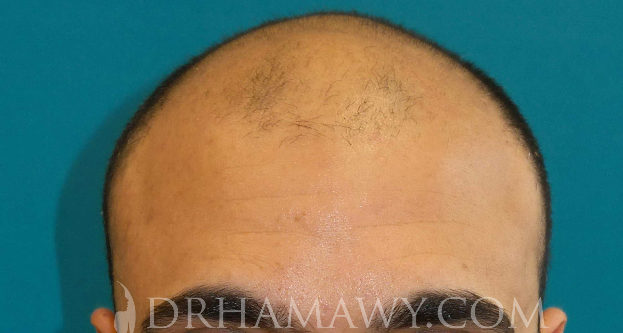 Hair Transplant Before and After | Princeton Plastic Surgeons