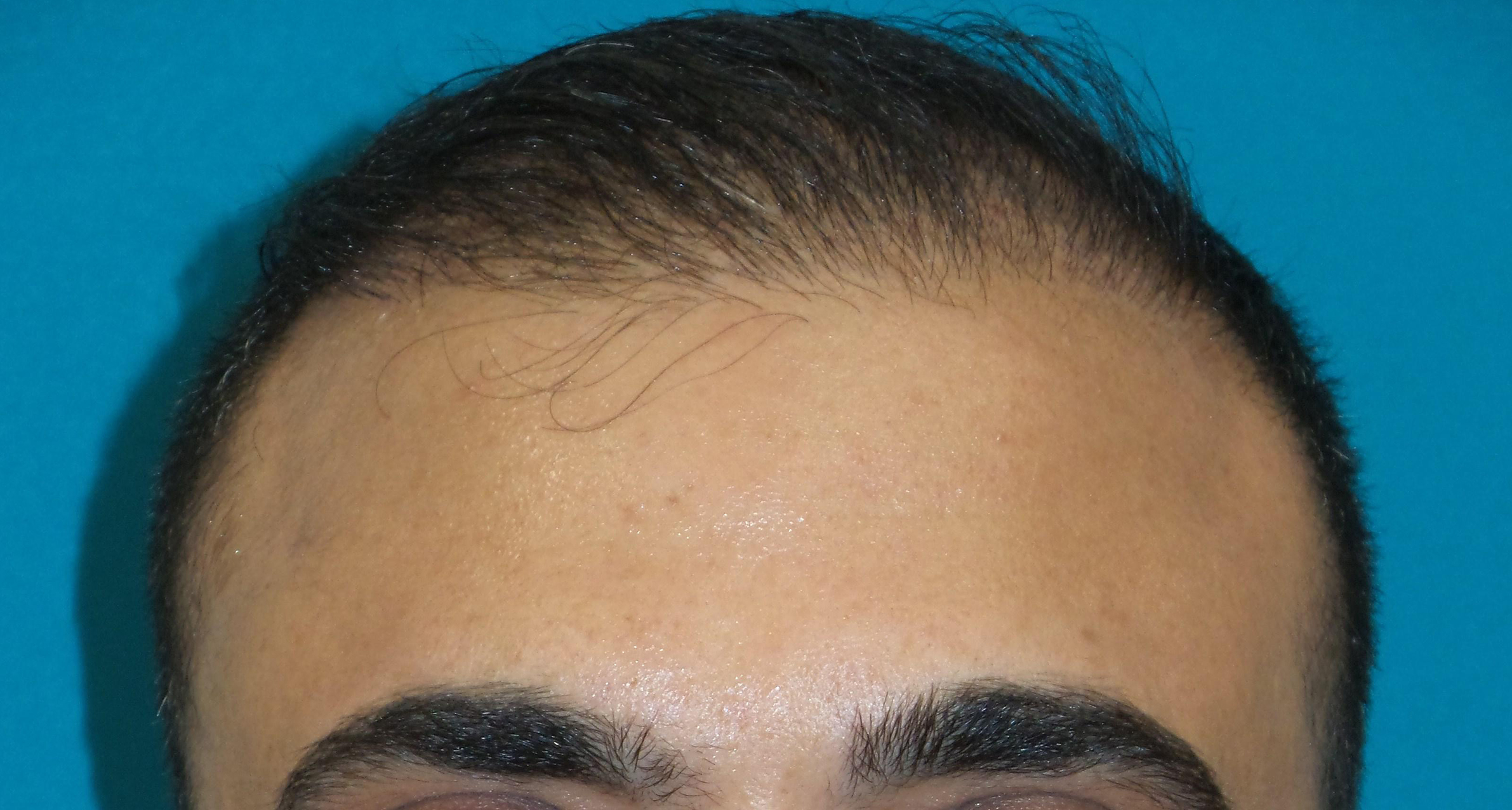 Hair Transplant Before and After | Princeton Plastic Surgeons