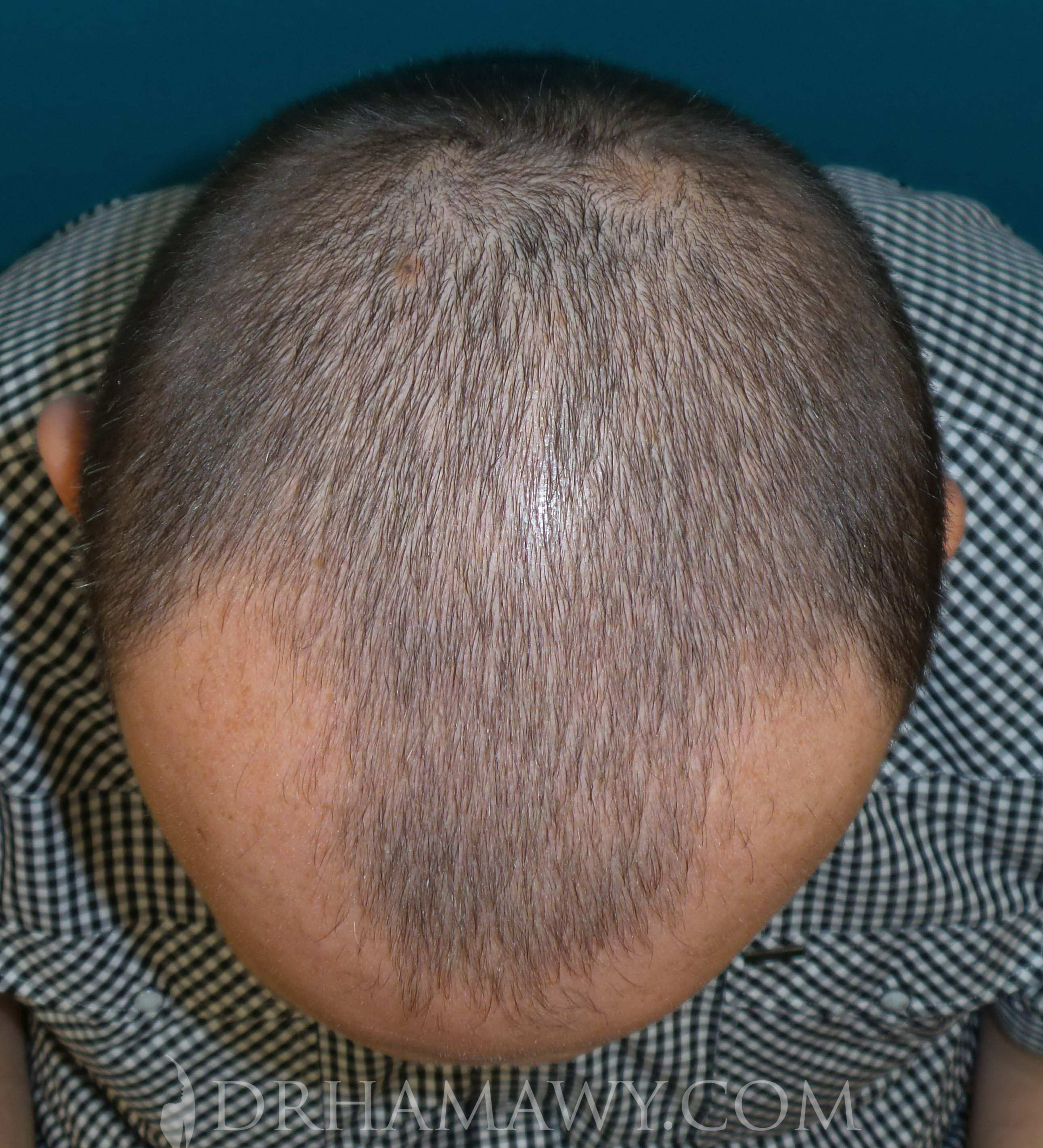 Hair Transplant Before and After | Princeton Plastic Surgeons