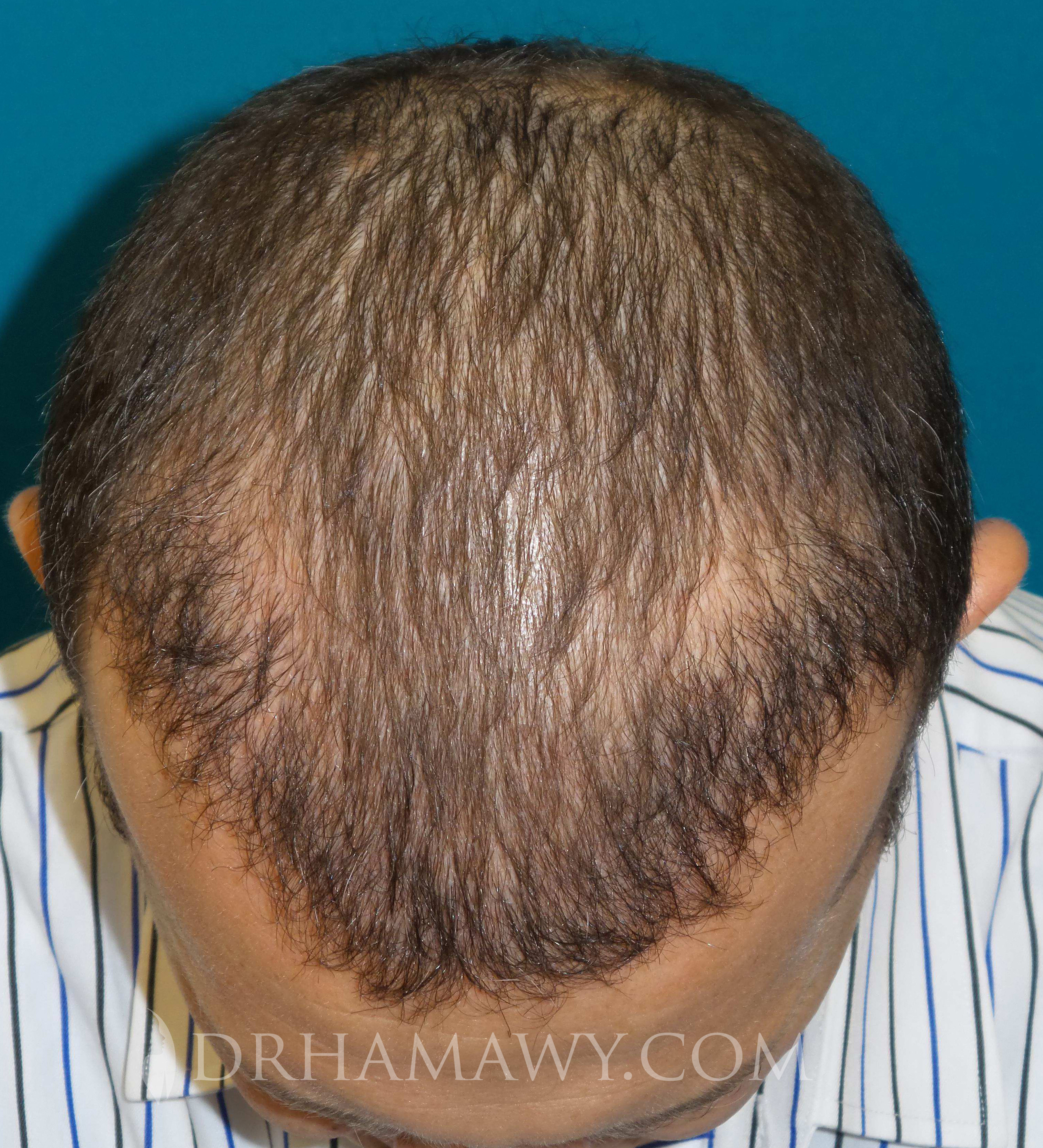 Hair Transplant Before and After | Princeton Plastic Surgeons