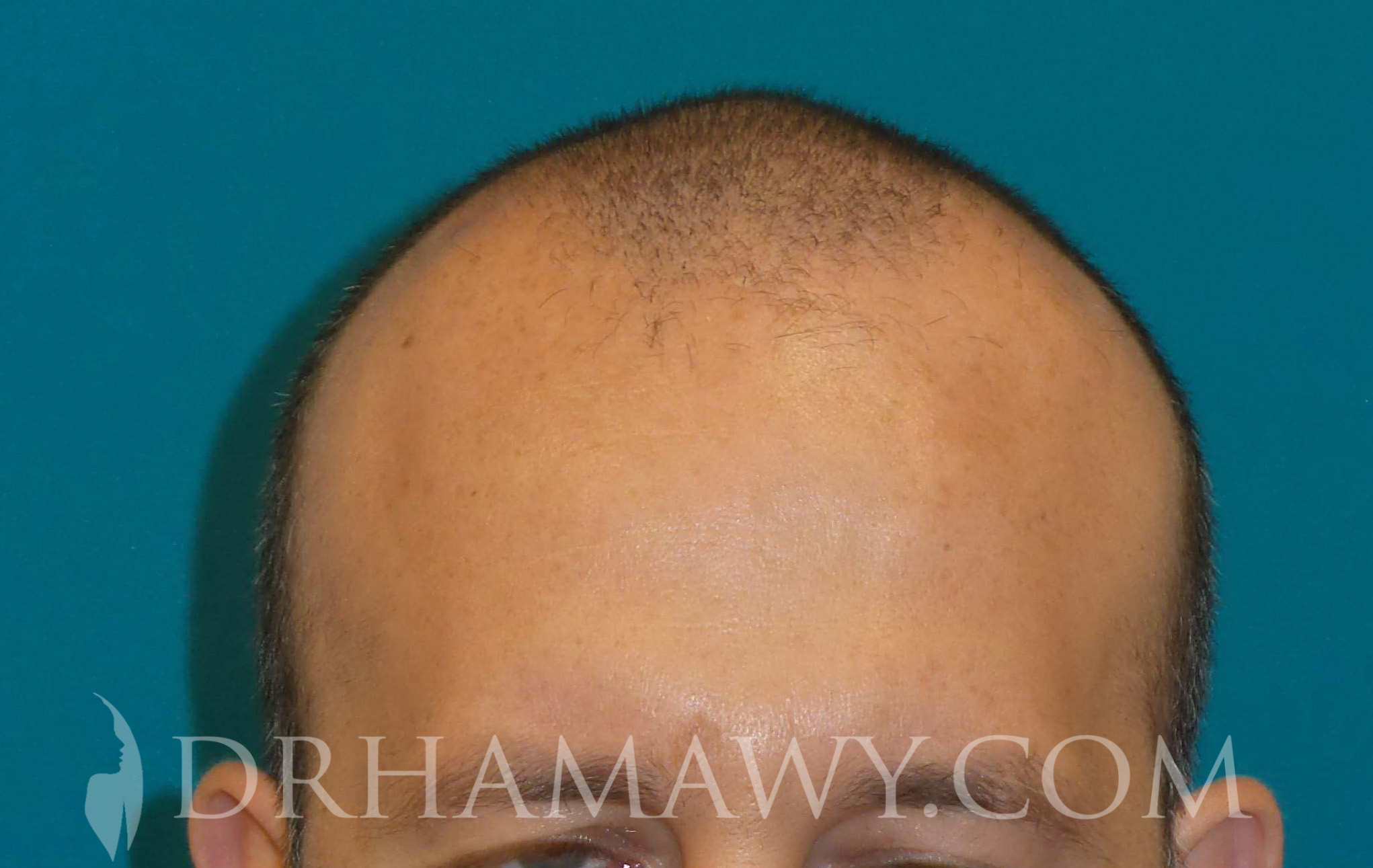 Hair Transplant Before and After | Princeton Plastic Surgeons