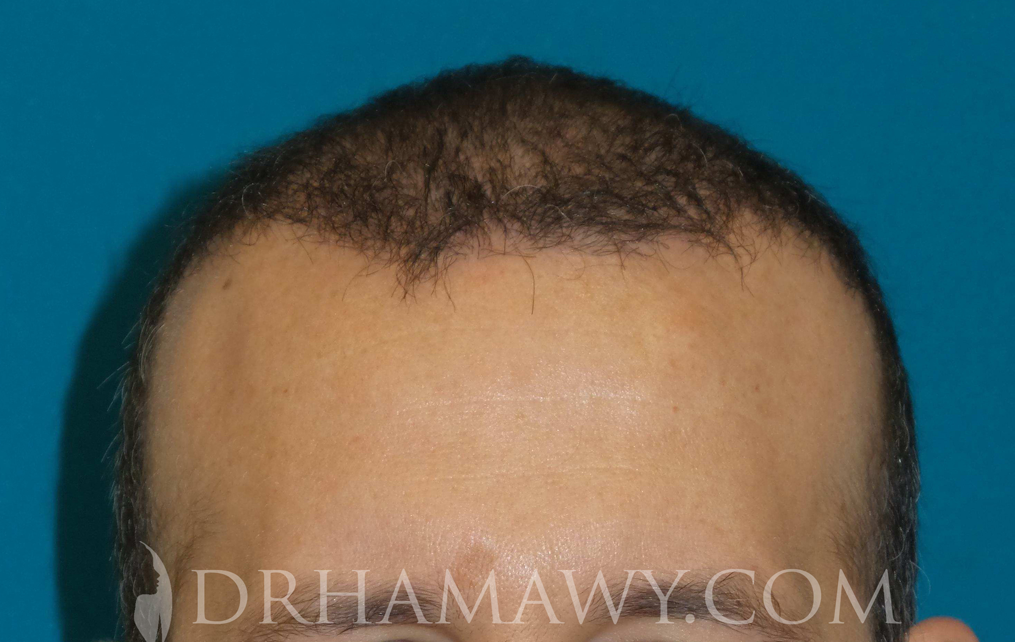 Hair Transplant Before and After | Princeton Plastic Surgeons