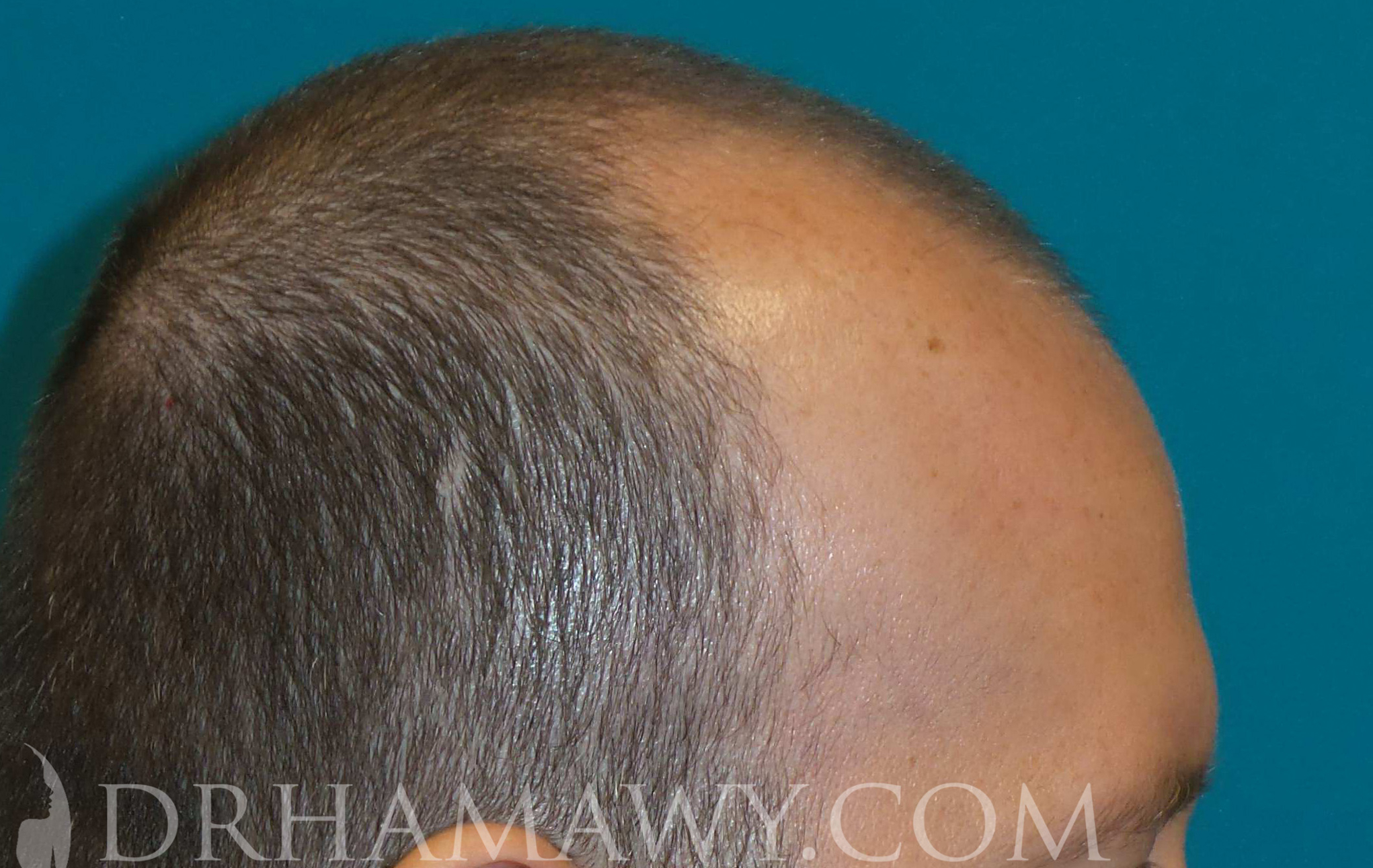 Hair Transplant Before and After | Princeton Plastic Surgeons