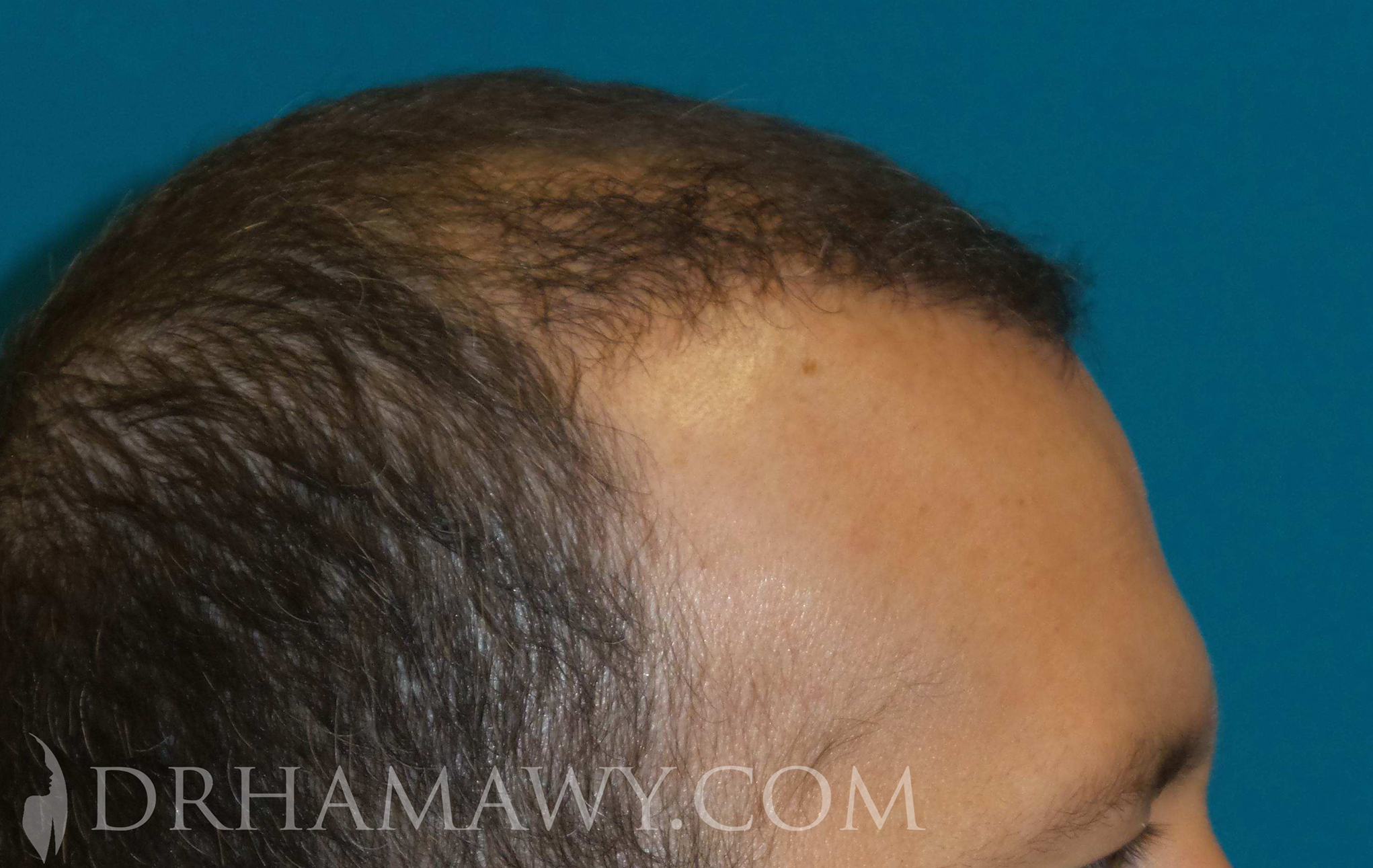 Hair Transplant Before and After | Princeton Plastic Surgeons