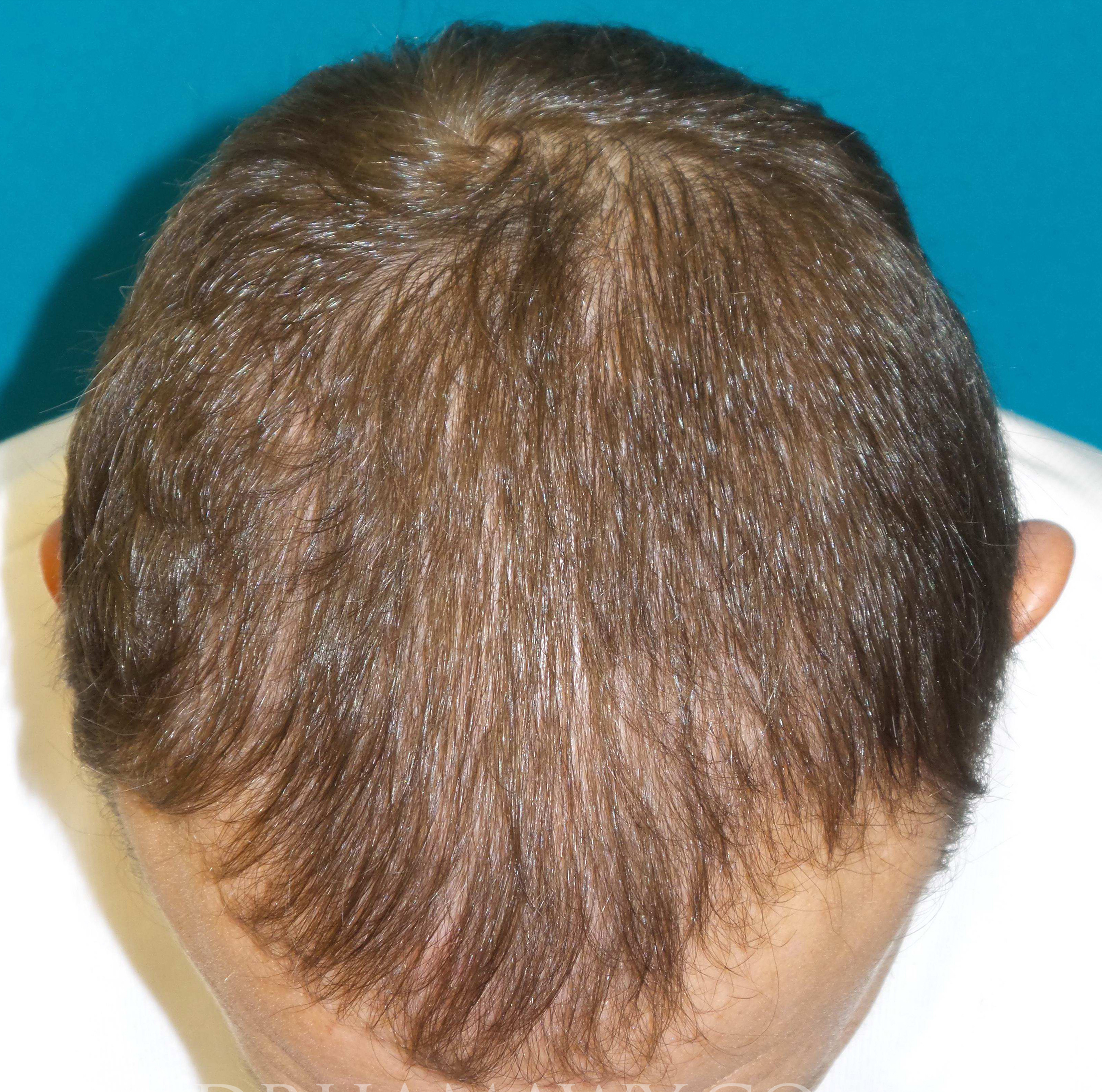 Hair Transplant Before and After | Princeton Plastic Surgeons