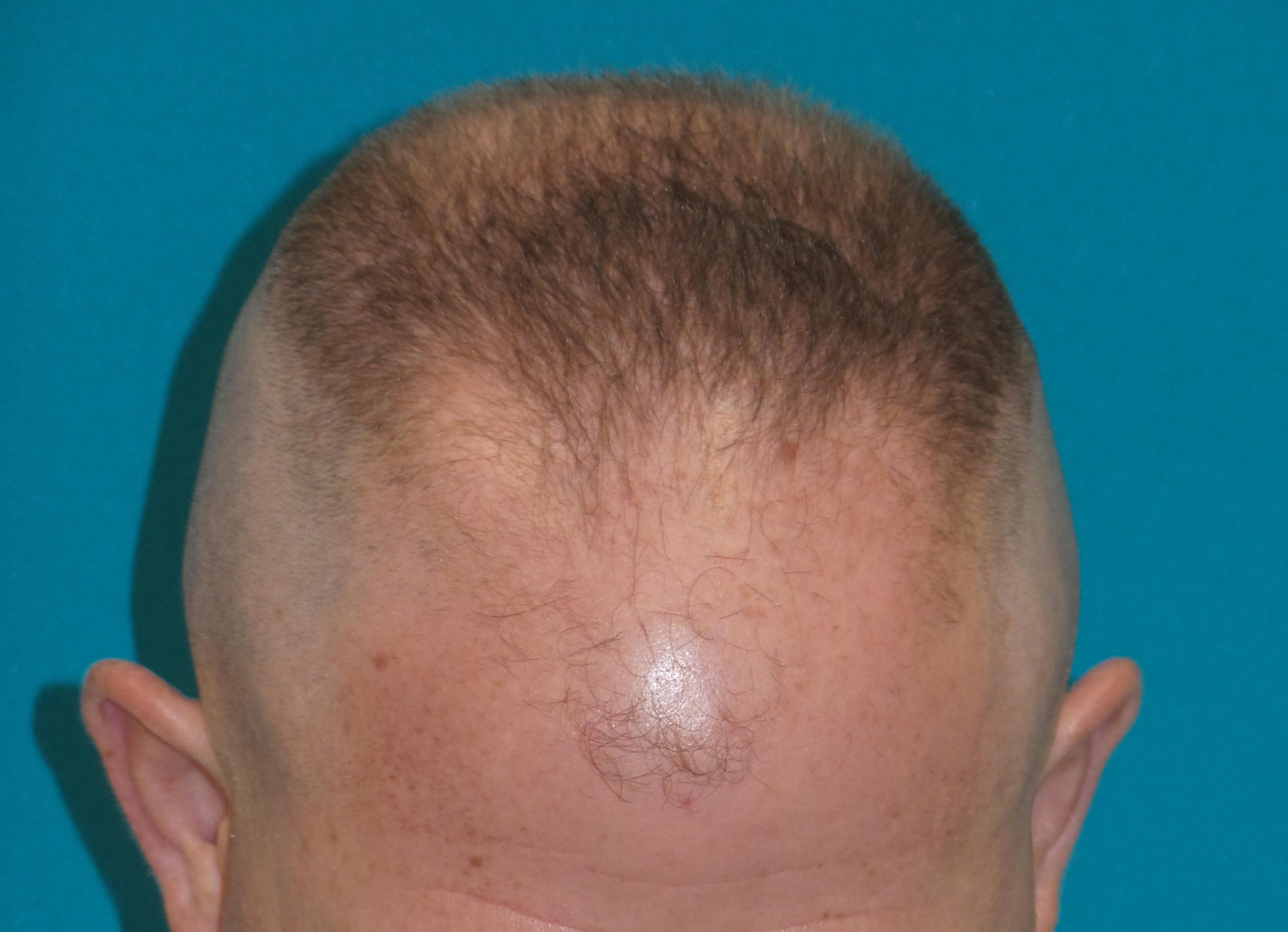 Hair Transplant Before and After | Princeton Plastic Surgeons