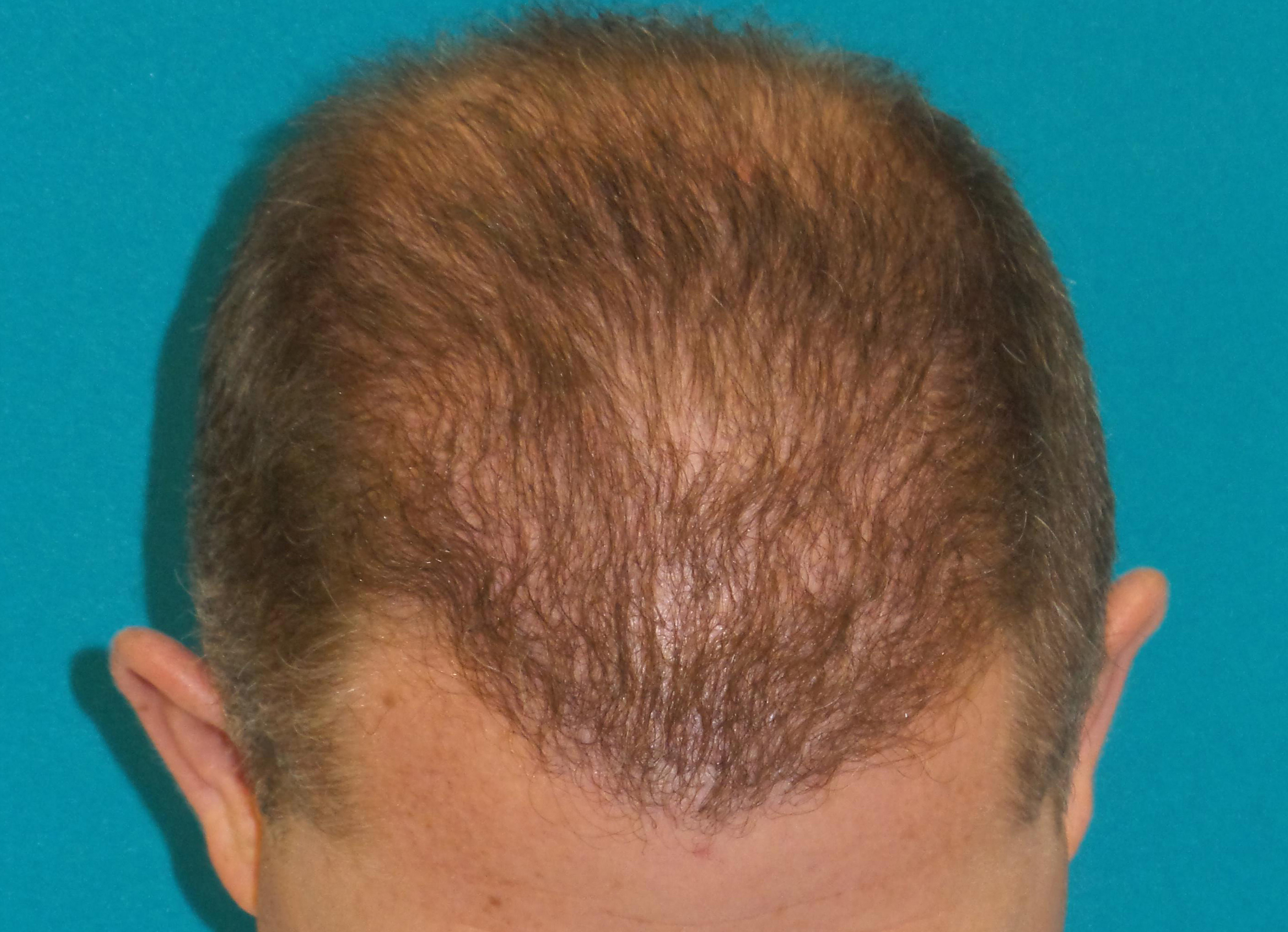 Hair Transplant Before and After | Princeton Plastic Surgeons