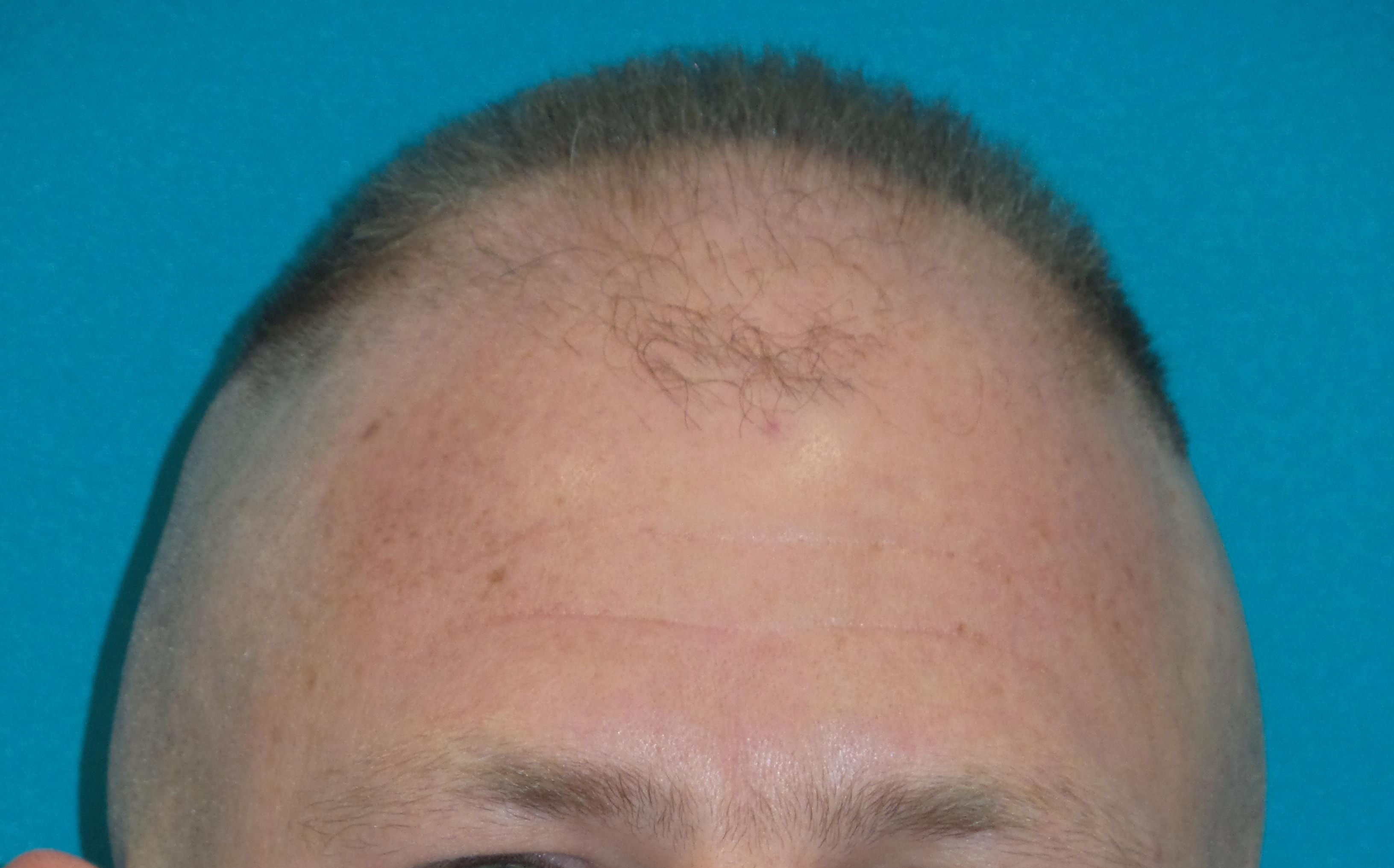 Hair Transplant Before and After | Princeton Plastic Surgeons