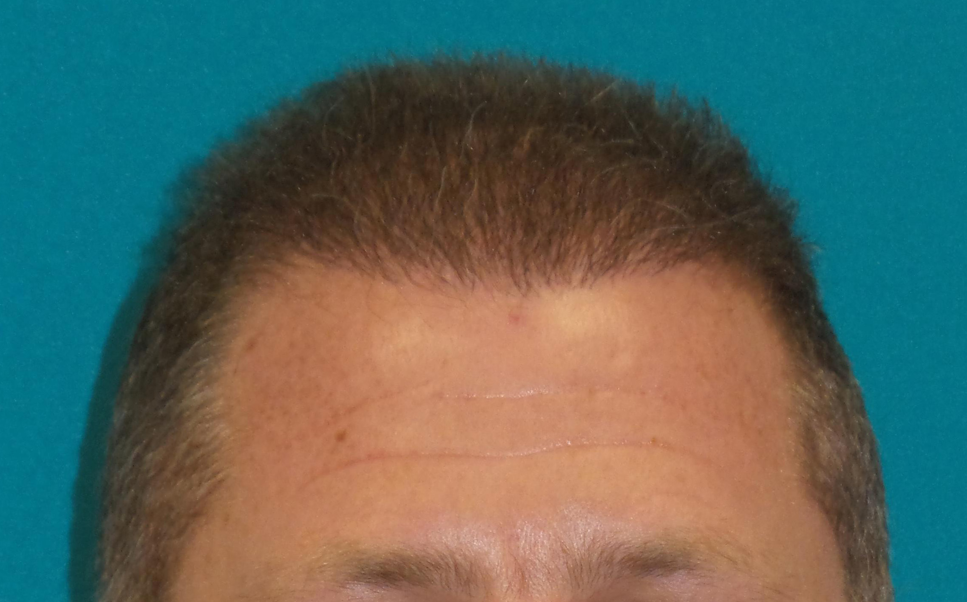 Hair Transplant Before and After | Princeton Plastic Surgeons